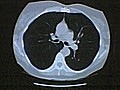 Early CT Scans Cut Lung Cancer Death Rate | BahVideo.com