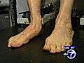 Treatment for aging flat feet | BahVideo.com