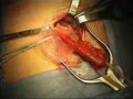 Hernia Repair A Mission | BahVideo.com