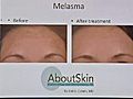 Dermatologist Joel Cohen Talks About Melasma | BahVideo.com