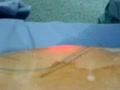 laser liposuction qatar | BahVideo.com