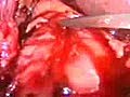 Laparoscopic Choledocolithotomy | BahVideo.com