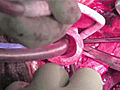 Landmark transplant uses stemcell windpipe | BahVideo.com
