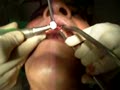 Oral Surgery - Preparation For Implant Part 2 | BahVideo.com