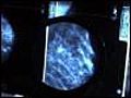 Surviving Mammograms | BahVideo.com