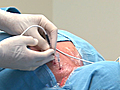 Latest Spine treatment CTV National News  | BahVideo.com