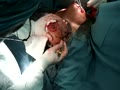breast surgery-mastopexy | BahVideo.com