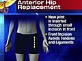 Anterior hip replacement surgery | BahVideo.com